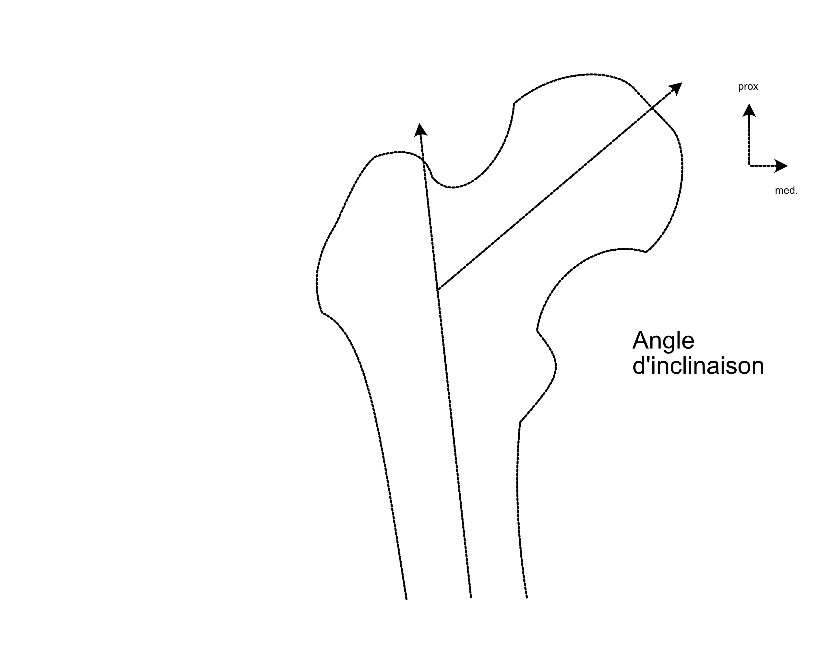 femur:angle d'inclinaison 