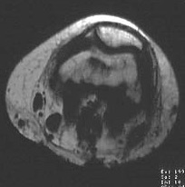  patella coupe transversale